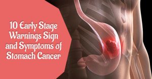 10 Early Stage Warnings Sign And Symptoms Of Stomach Cancer