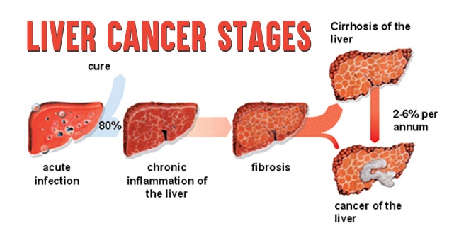 Liver Cancer Stages How Stages Of Lung Cancer Are Determined 