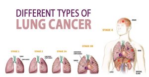 Types of Lung Cancer - Symptoms, Causes and Difference