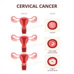 Cervical Cancer Diagnosis and Treatment Options