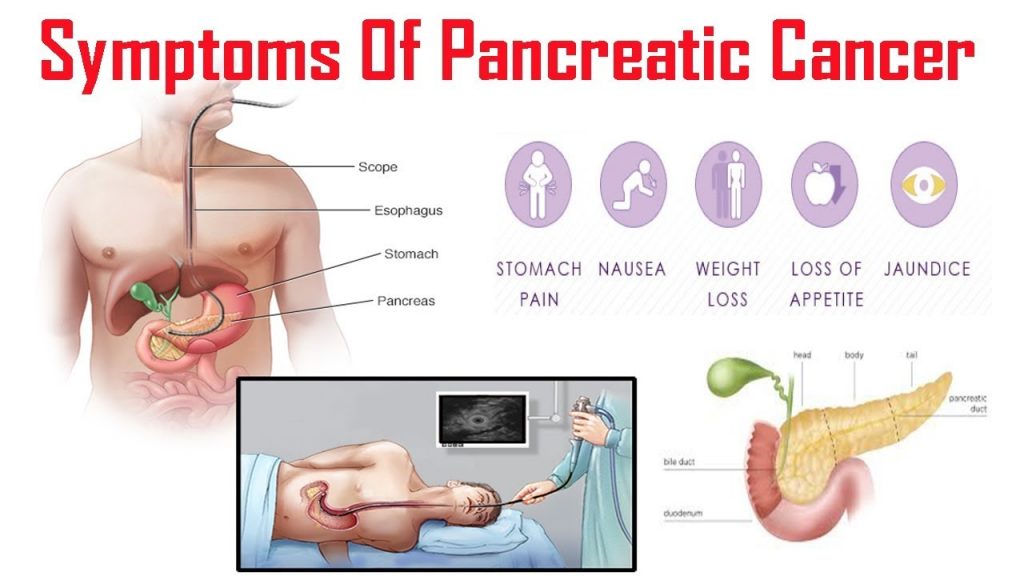 Pancreatic Cancer - Causes, Risk Factors, Symptoms, Prevention