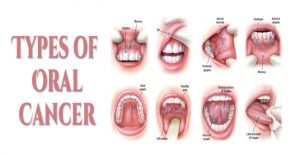 Different Types of Oral / Mouth Cancers