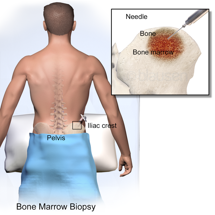 biopsy for bone marrow